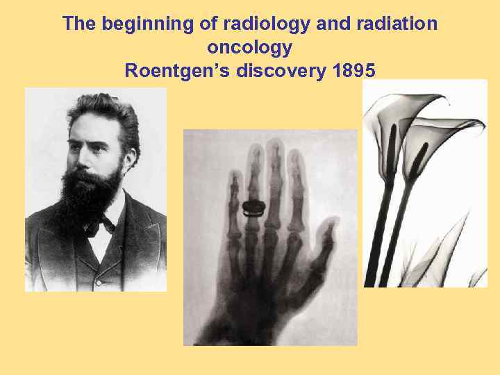 The beginning of radiology and radiation oncology Roentgen’s discovery 1895 