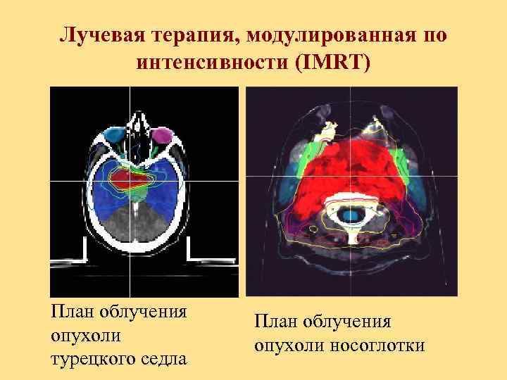 Лучевая терапия, модулированная по интенсивности (IMRT) План облучения опухоли турецкого седла План облучения опухоли