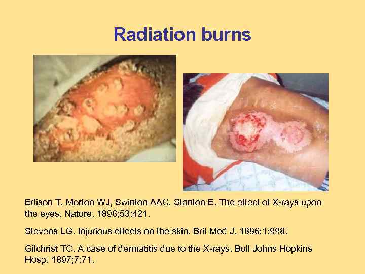 Radiation burns Edison T, Morton WJ, Swinton AAC, Stanton E. The effect of X-rays