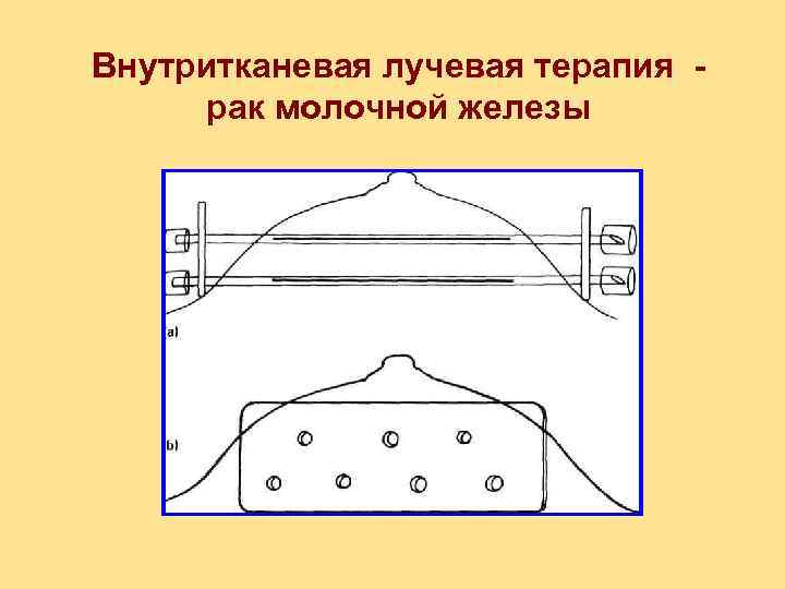 Внутритканевая лучевая терапия рак молочной железы 