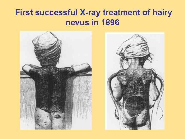 First successful X-ray treatment of hairy nevus in 1896 