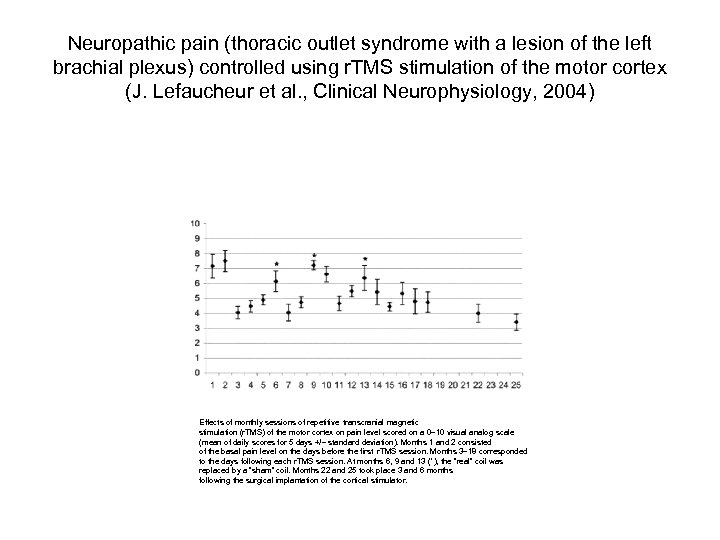 Neuropathic pain (thoracic outlet syndrome with a lesion of the left brachial plexus) controlled