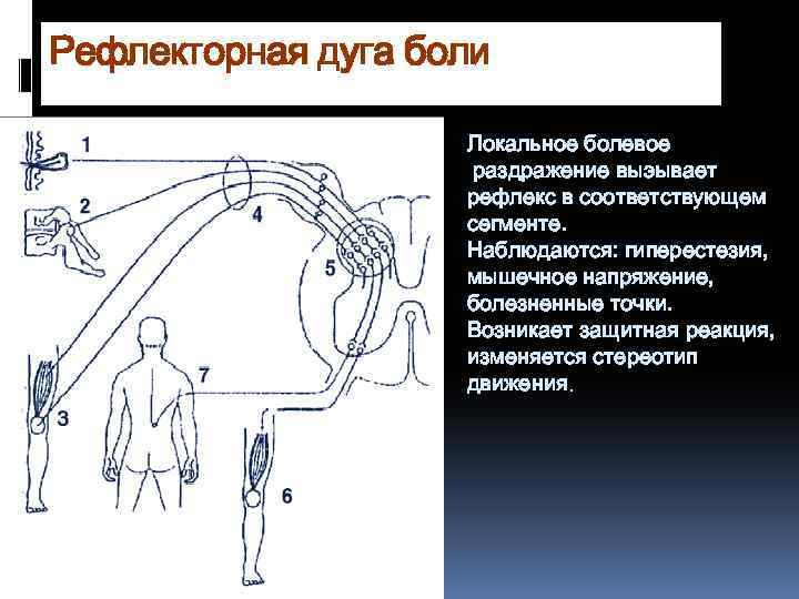 Рефлекторная дуга боли Локальное болевое раздражение выэывает рефлекс в соответствующем сегменте. Наблюдаются: гиперестезия, мышечное