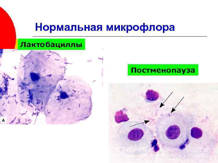 Цитологическая картина лактобациллеза