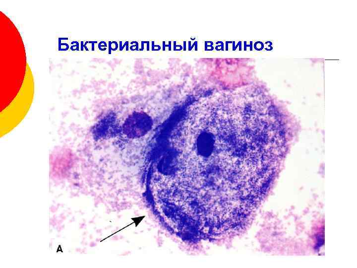 Цитологическая картина лактобациллеза