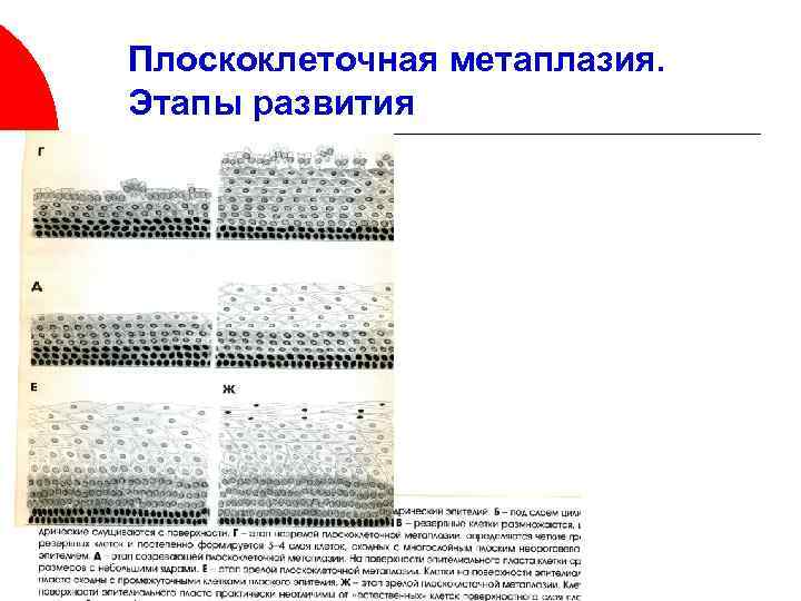 Эктопия с плоскоклеточной метаплазией. Плоскоклеточная метаплазия эпителия шейки матки. Метаплазированный эпителий. Незрелая плоскоклеточная метаплазия.