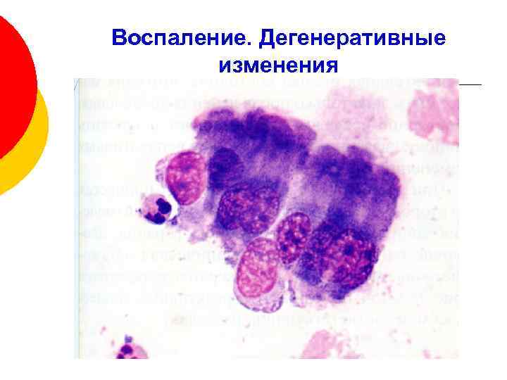 Цитологическая картина воспалительного процесса что это