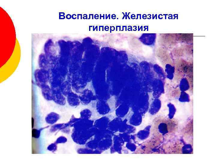 Железистая гиперплазия