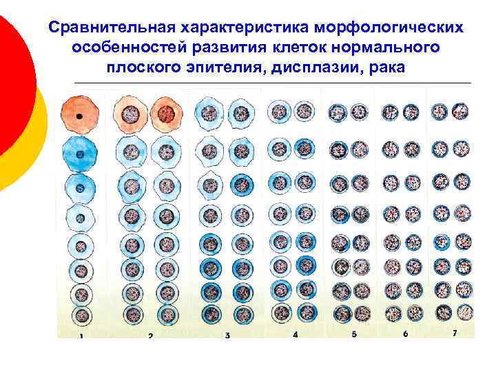 Сравнительная характеристика морфологических особенностей развития клеток нормального плоского эпителия, дисплазии, рака 