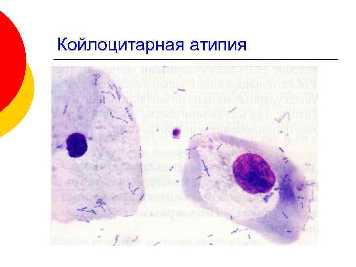 Койлоцитарная атипия. Койлоциты эктопия. Атипия клеток плоского эпителия.