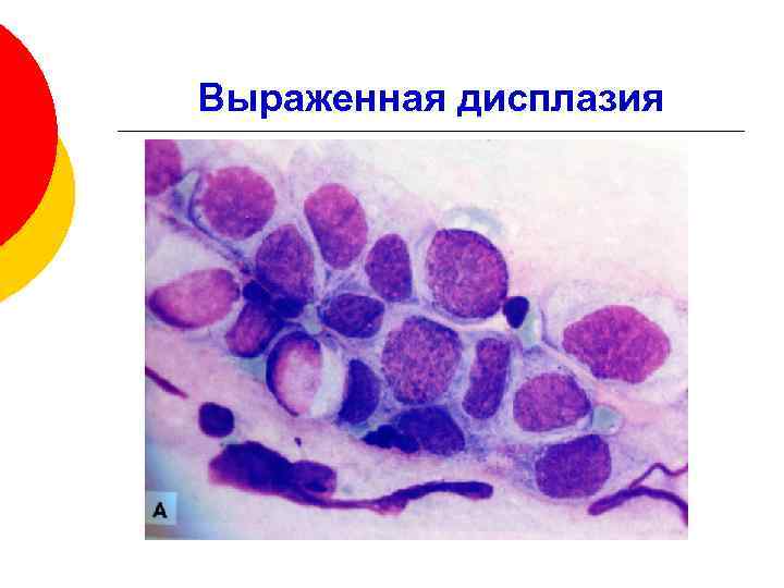 Выраженная дисплазия 