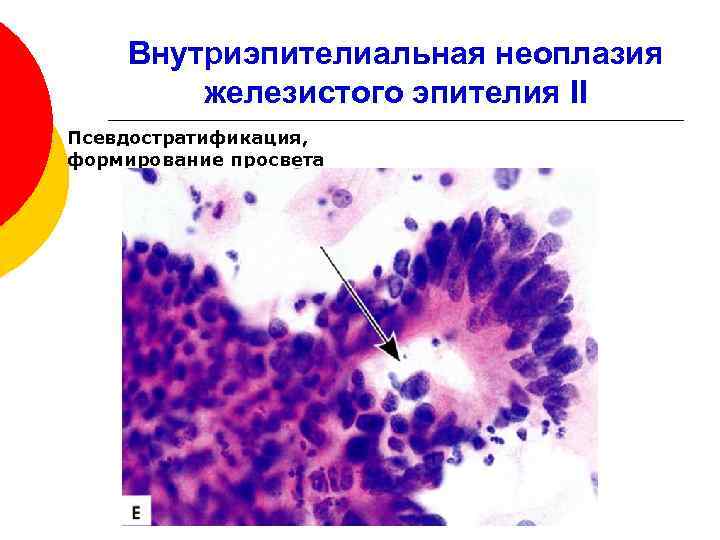 Воспаление с реактивными изменениями клеток. Дисплазия шейки матки цитология. Гиперплазия железистого эпителия цитология. Дисплазия клеток плоского эпителия.