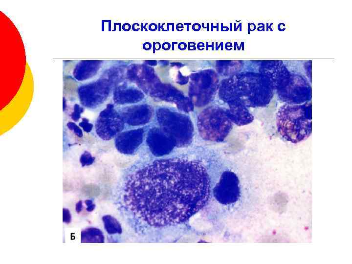 Аденокарцинома цитологическая картина