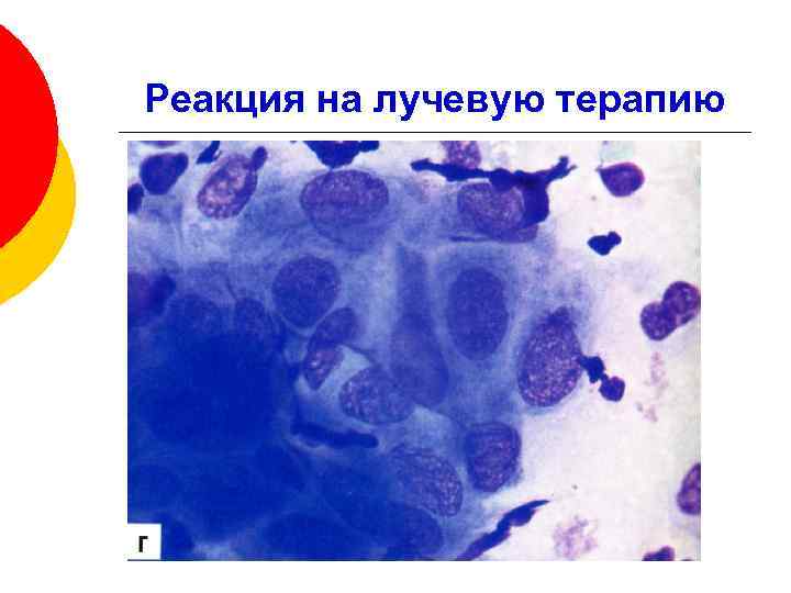 Реакция на лучевую терапию 
