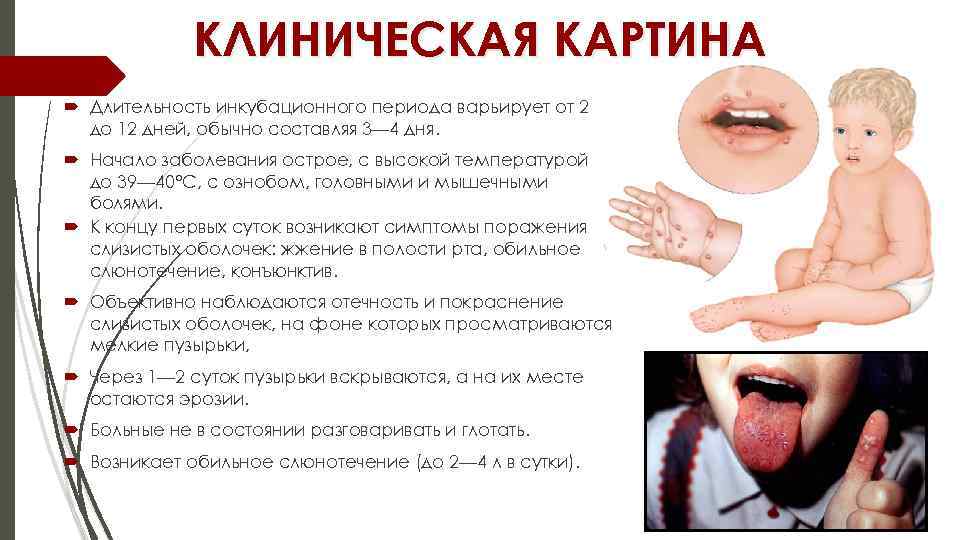 КЛИНИЧЕСКАЯ КАРТИНА Длительность инкубационного периода варьирует от 2 до 12 дней, обычно составляя 3—