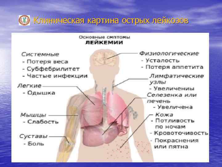 Лейкоз клиническая картина. Классификация острых лейкозов. Острый лейкоз у детей классификация.