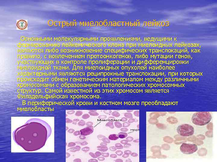 Острый миелобластный лейкоз Основными молекулярными проявлениями, ведущими к формированию лейкемического клона при миелоидных лейкозах,