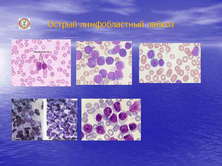 Острый лимфобластный лейкоз В 