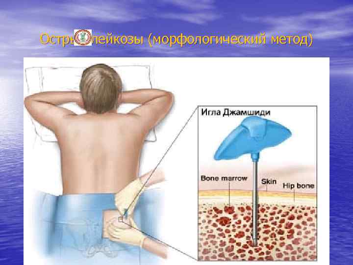 Острые лейкозы (морфологический метод) 