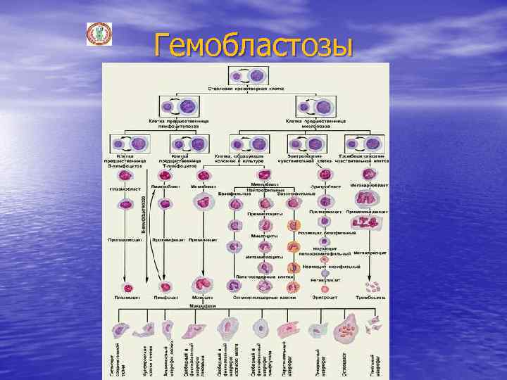 Гемобластозы 