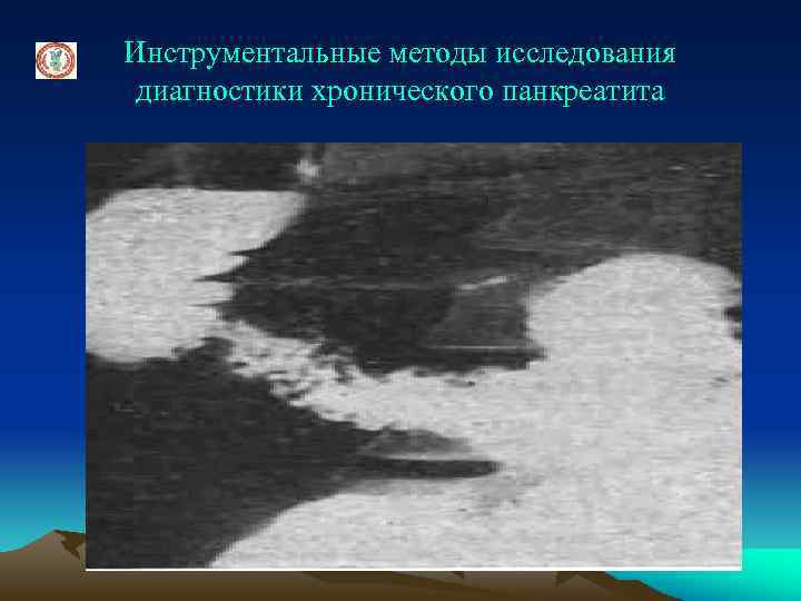 Инструментальные методы исследования диагностики хронического панкреатита 