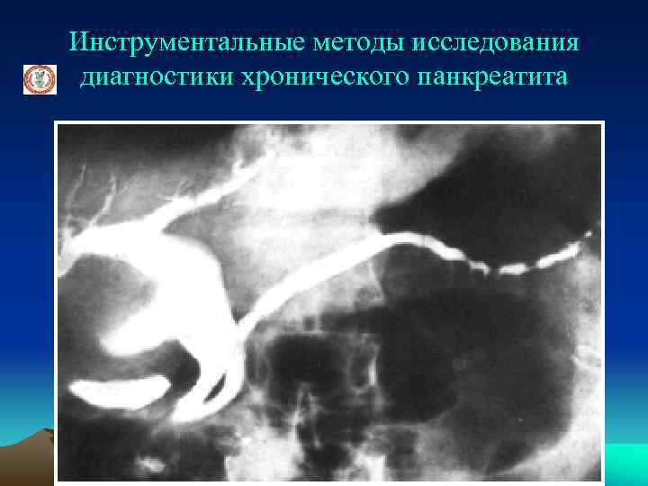 Инструментальные методы исследования диагностики хронического панкреатита 