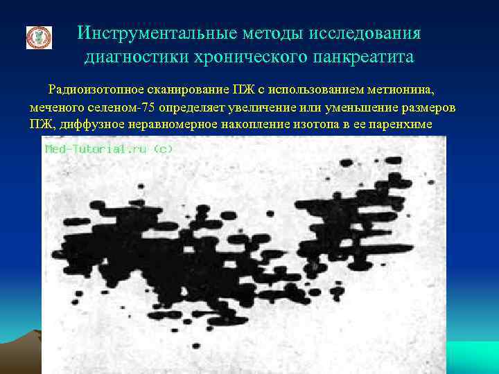 Инструментальные методы исследования диагностики хронического панкреатита Радиоизотопное сканирование ПЖ с использованием метионина, меченого селеном-75