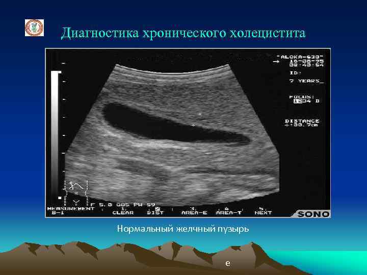 Диагностика хронического холецистита Нормальный желчный пузырь е 