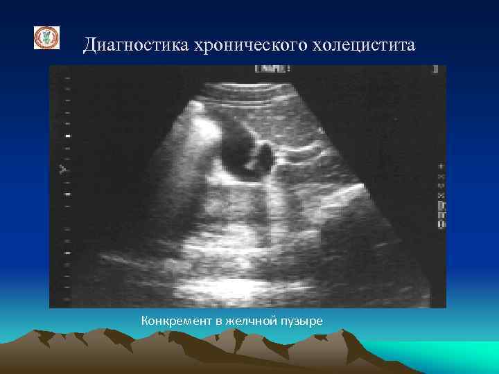 Диагностика хронического холецистита Конкремент в желчной пузыре 