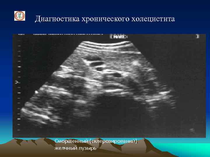 Диагностика хронического холецистита Сморщенный (склерозированнй) желчный пузырь 