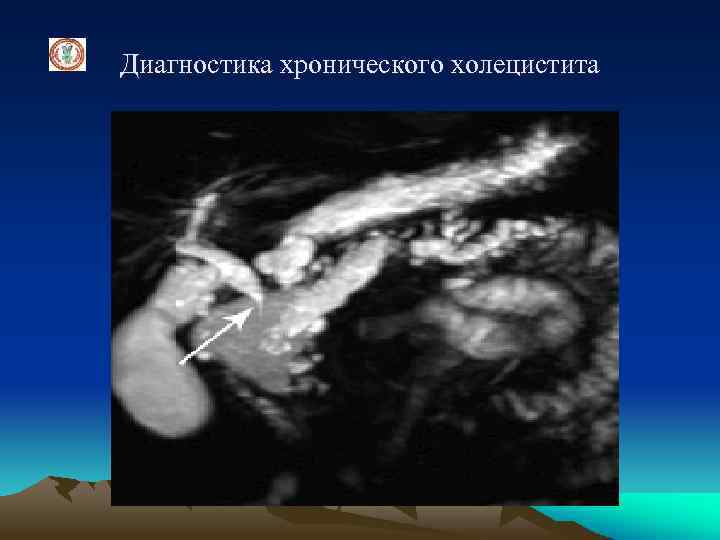 Диагностика хронического холецистита 