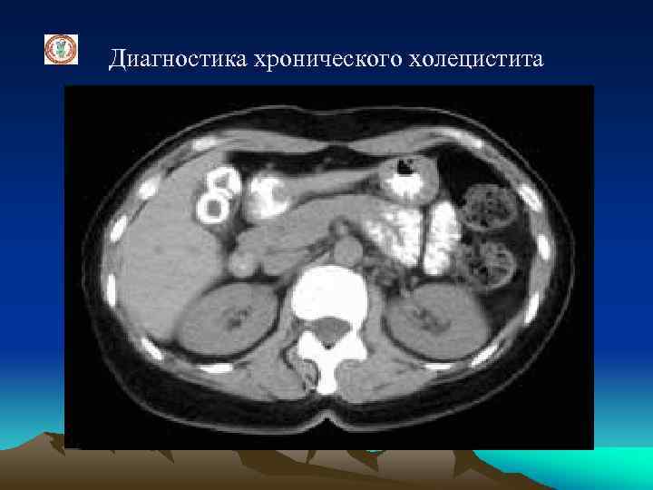 Диагностика хронического холецистита 