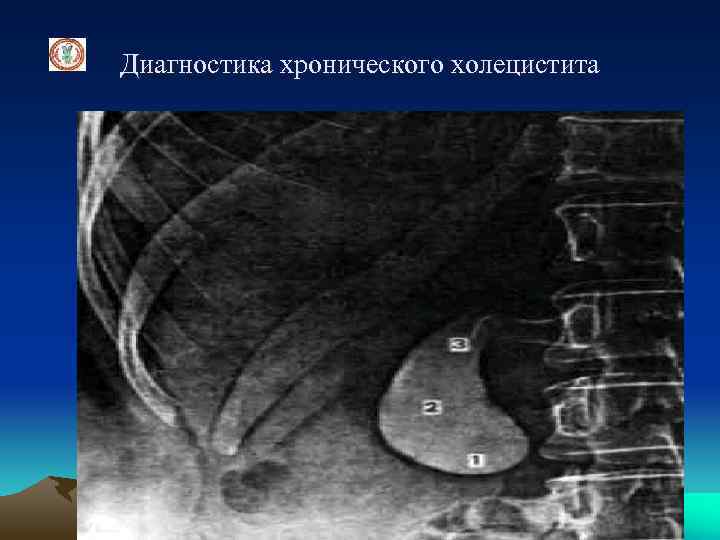 Диагностика хронического холецистита 