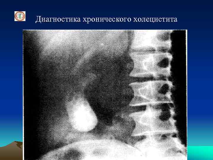 Диагностика хронического холецистита 