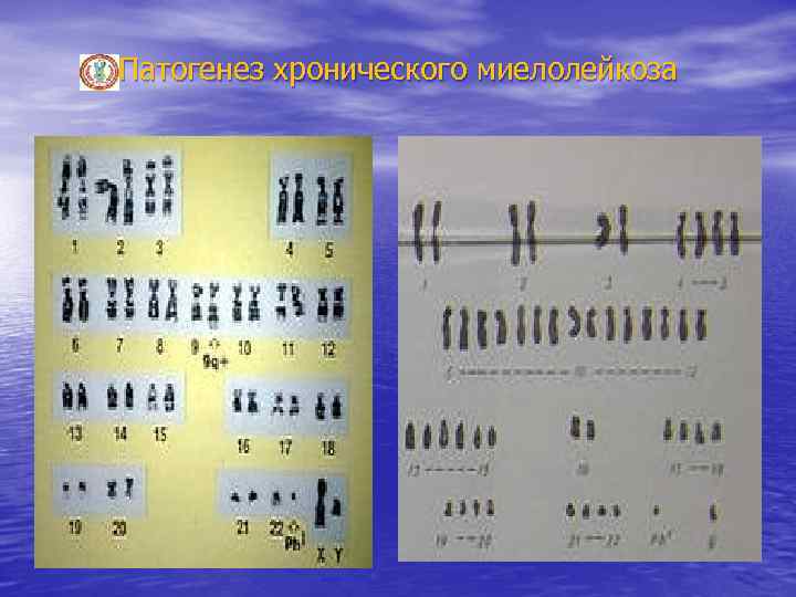 Патогенез хронического миелолейкоза 