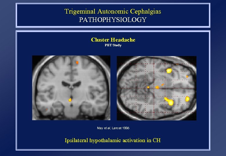 Trigeminal Autonomic Cephalgias PATHOPHYSIOLOGY Cluster Headache PET Study May et al, Lancet 1998 Ipsilateral