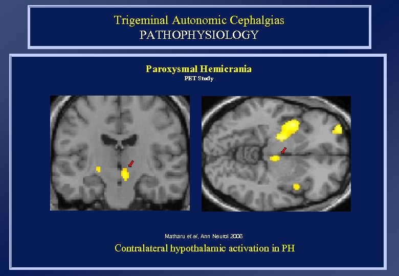 Trigeminal Autonomic Cephalgias PATHOPHYSIOLOGY Paroxysmal Hemicrania PET Study Matharu et al, Ann Neurol 2006