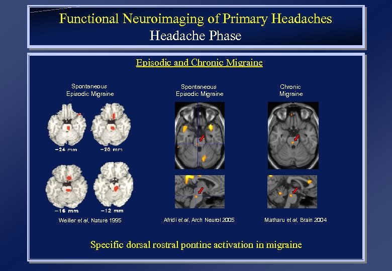 Functional Neuroimaging of Primary Headaches Headache Phase Episodic and Chronic Migraine Spontaneous Episodic Migraine
