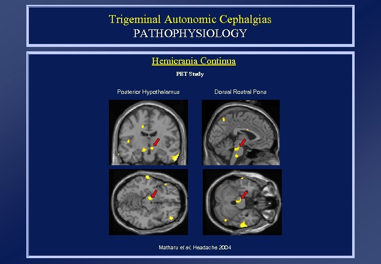 Trigeminal Autonomic Cephalgias PATHOPHYSIOLOGY Hemicrania Continua PET Study Posterior Hypothalamus Dorsal Rostral Pons Matharu