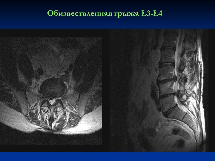 Обизвествленная грыжа L 3 -L 4 