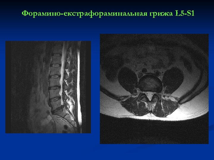 Форамино-екстрафораминальная грижа L 5 -S 1 