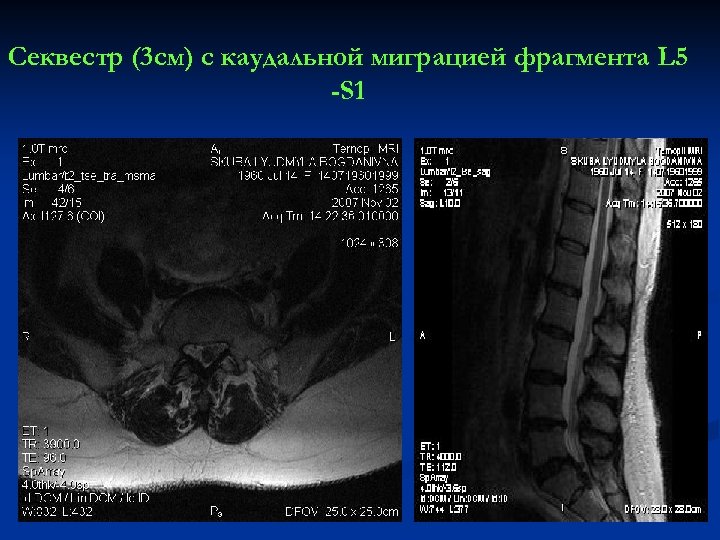 Секвестр (3 см) с каудальной миграцией фрагмента L 5 -S 1 