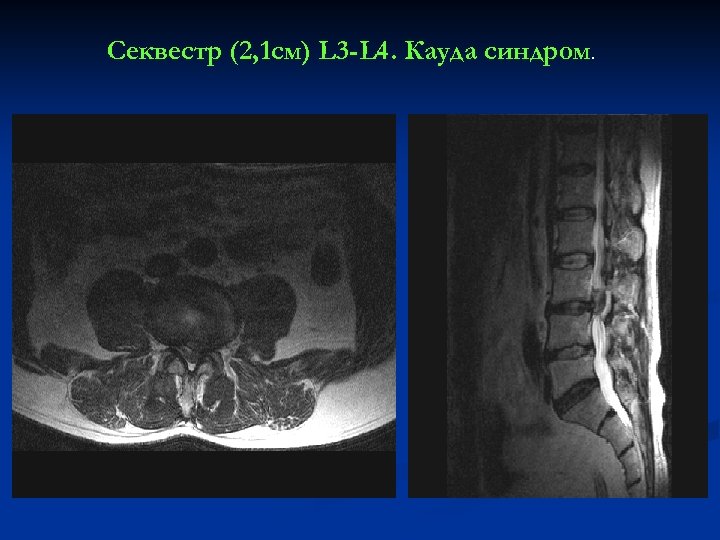 Секвестр (2, 1 см) L 3 -L 4. Кауда синдром. 