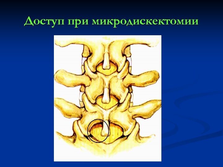 Доступ при микродискектомии 