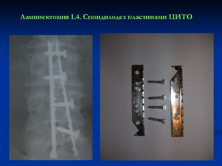 Ламинектомия L 4. Спондилодез пластинами ЦИТО 