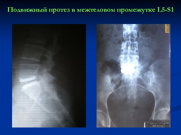 Подвижный протез в межтеловом промежутке L 5 -S 1 