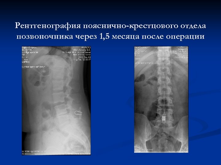 Рентгенография пояснично-крестцового отдела позвоночника через 1, 5 месяца после операции 