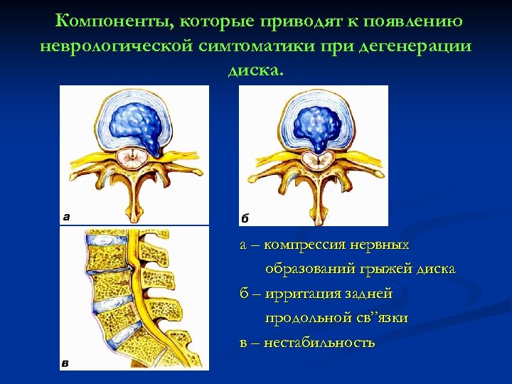 Компоненты, которые приводят к появлению неврологической симтоматики при дегенерации диска. а – компрессия нервных