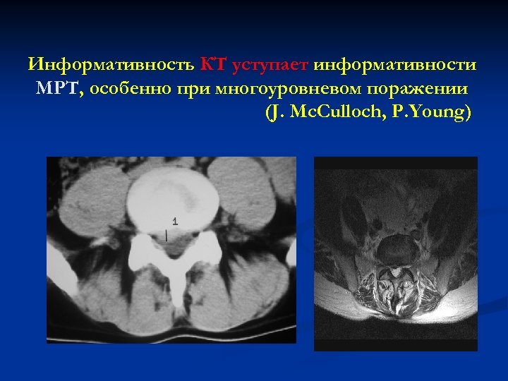 Информативность КТ уступает информативности МРТ, особенно при многоуровневом поражении (J. Mc. Culloch, P. Young)