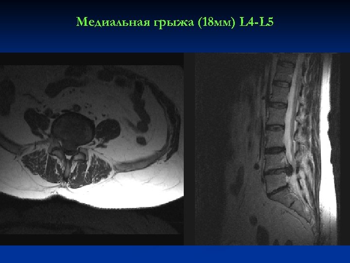 Медиальная грыжа (18 мм) L 4 -L 5 